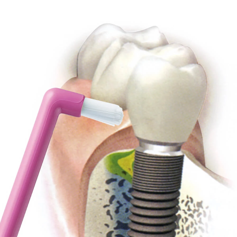 Зубные щетки для протезов на имплантах физрастворы для ингалятора