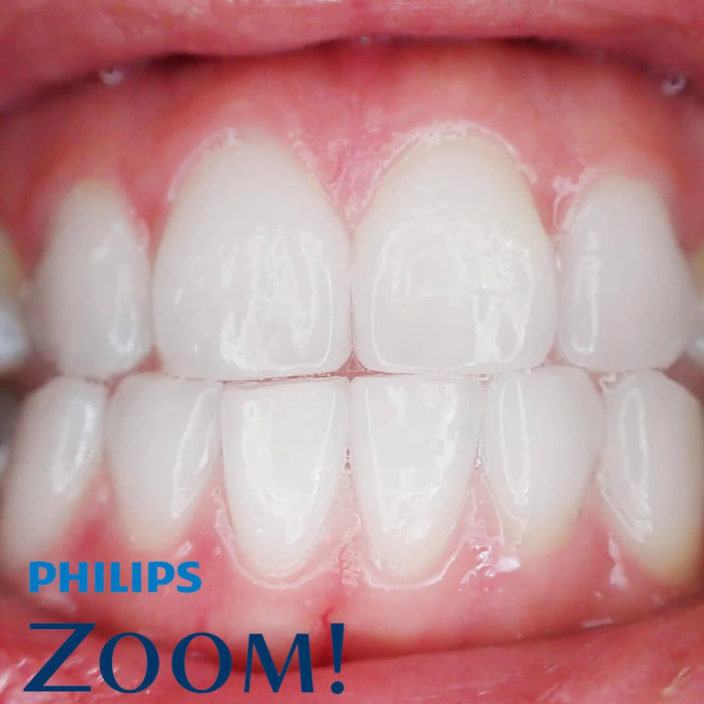 Philips Zoom NightWhite 16%CP (карбамид пероксид гел) средство за ноќно белење заби